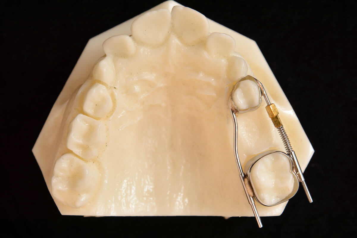 Expansion and Arch Development Parklund Orthodontic Lab