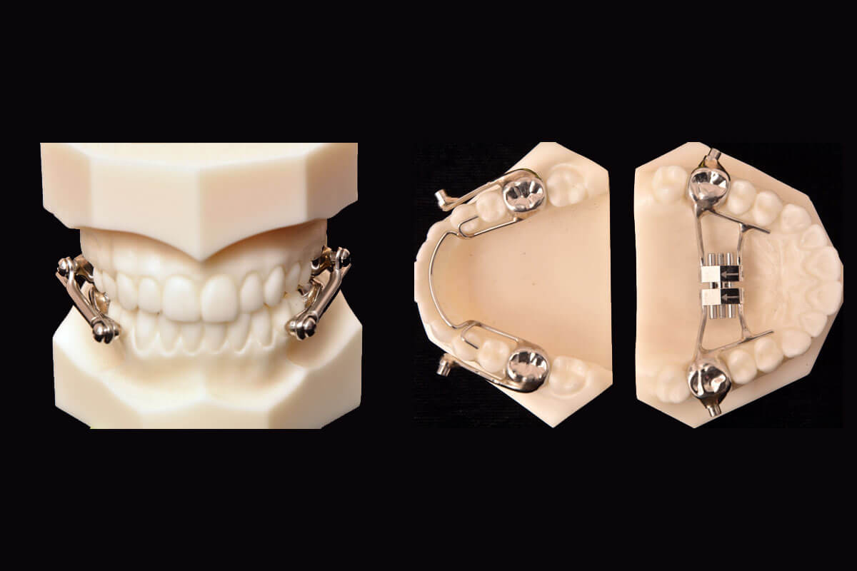 Herbst Parklund Orthodontic Lab