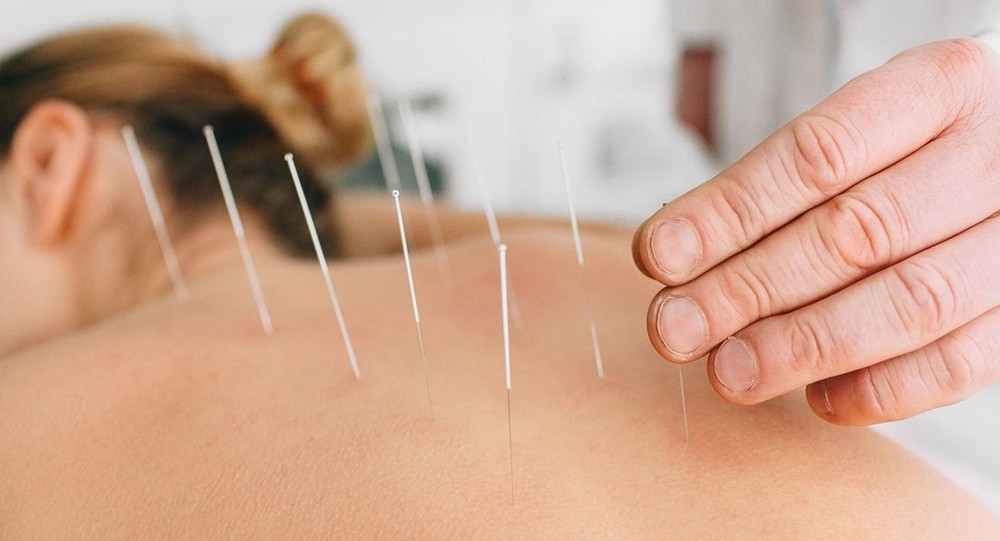 L’acupuncture, une méthode thérapeutique née en orient parole de vie