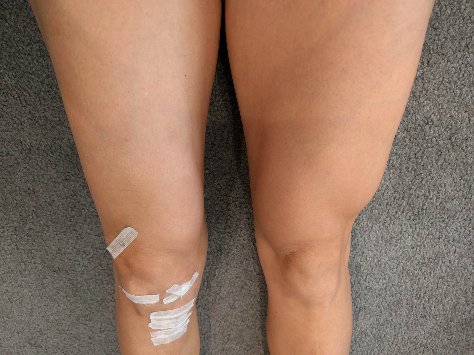 Climber's Guide to ACL Surgery Part 2 patchwork&pebbles