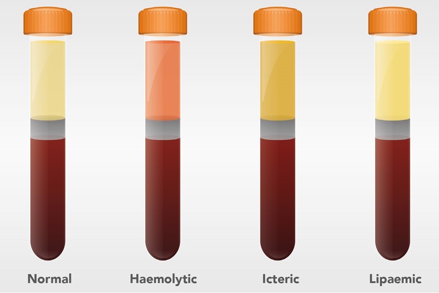 Preanalytical errors how to detect and interpret HIL interference