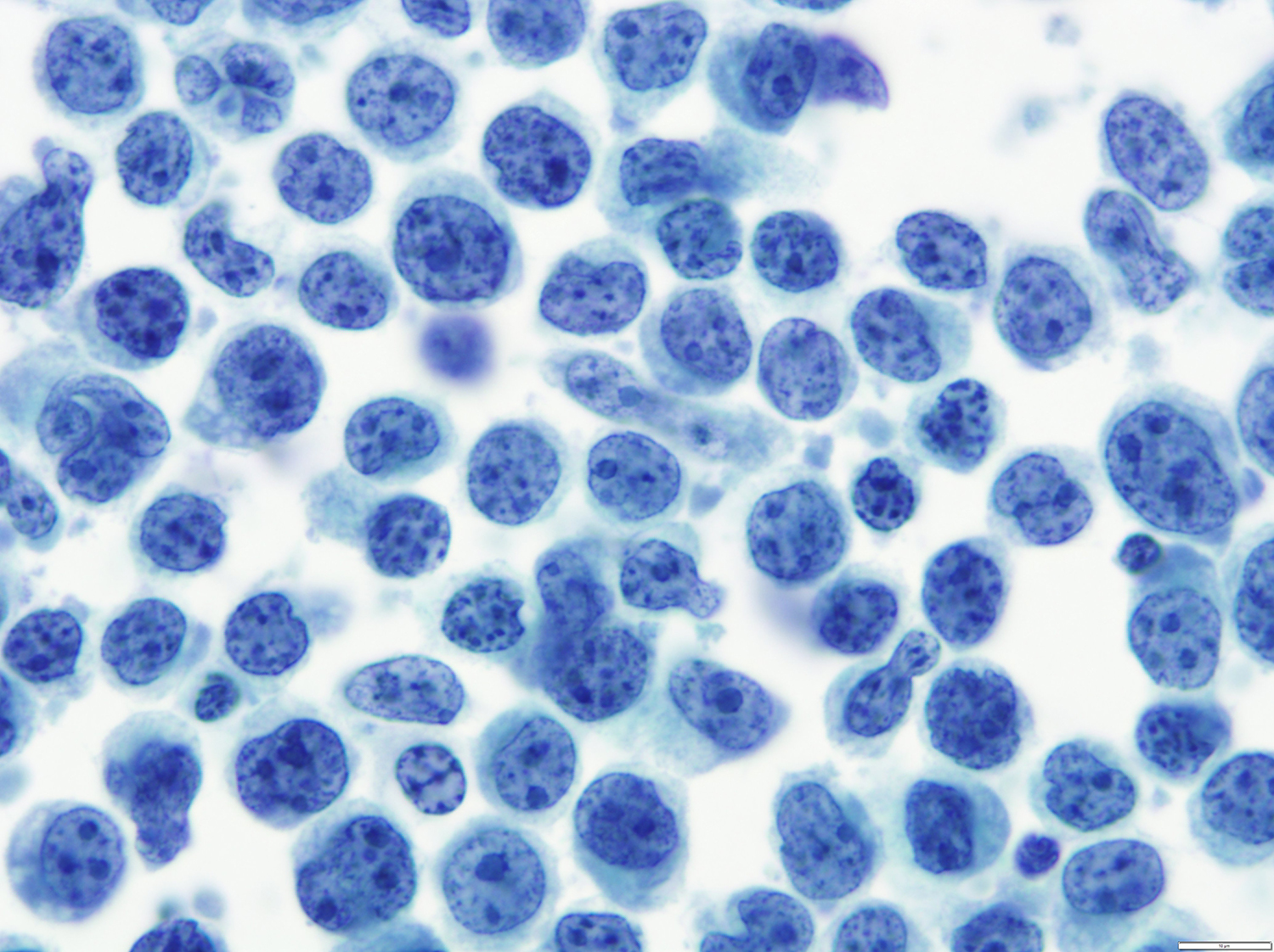 Pathology Outlines Primary effusion lymphoma
