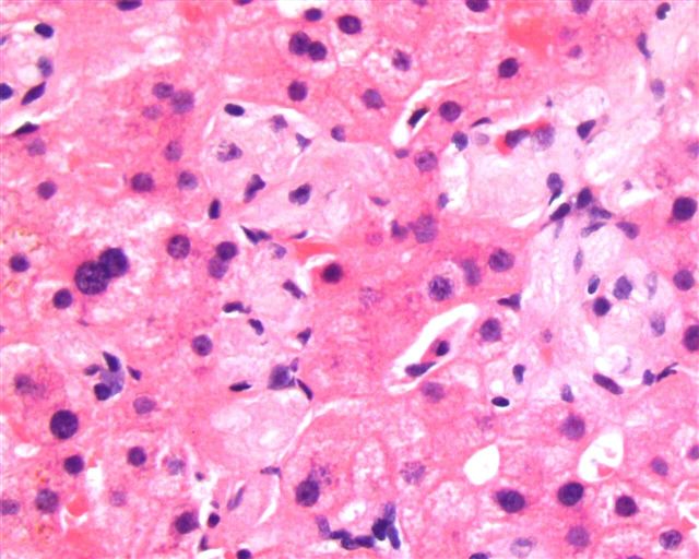 Pathology Outlines Gaucher disease