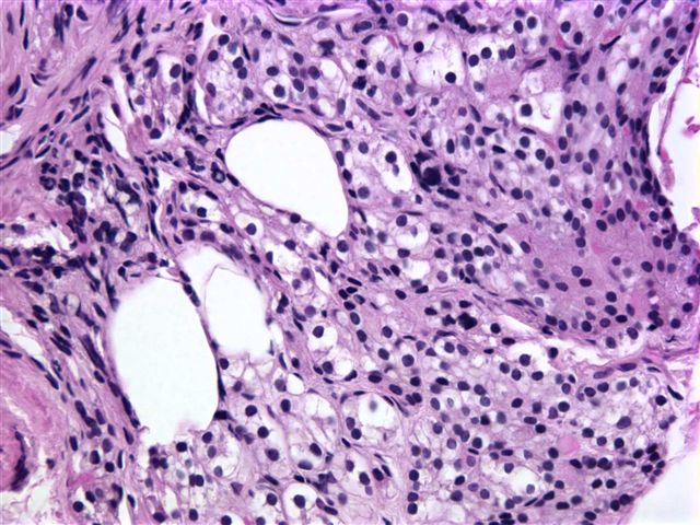 Pathology Outlines Ectopic parathyroid tissue