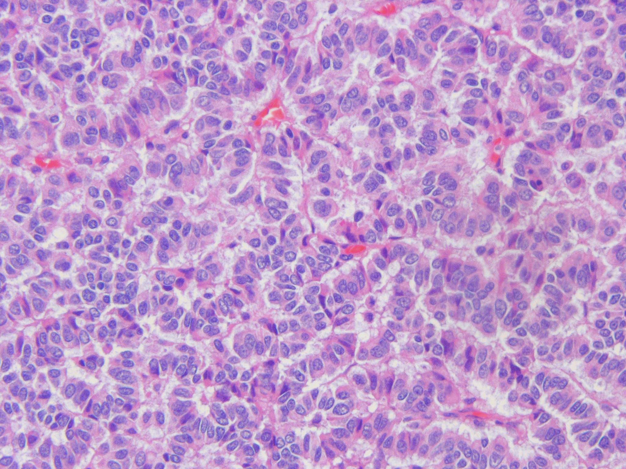 Pathology Outlines Well differentiated neuroendocrine tumor (carcinoid)