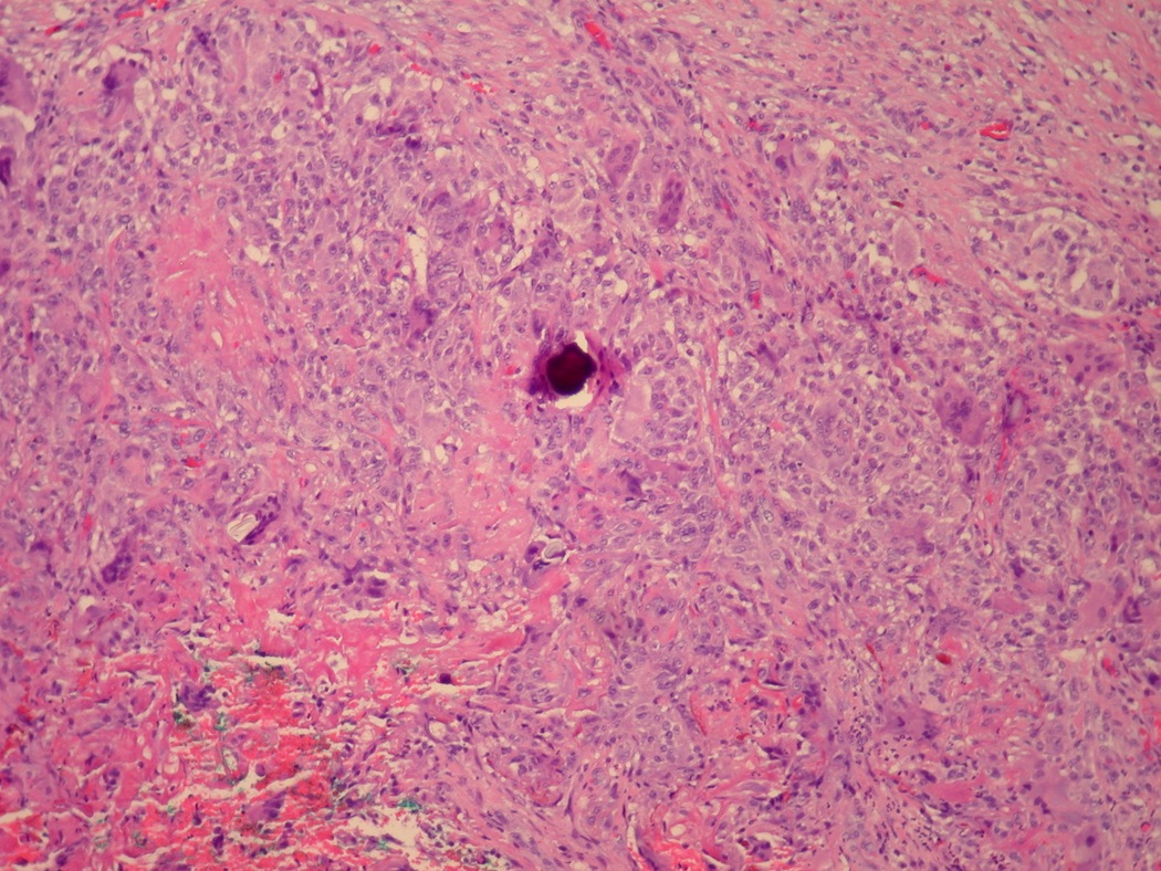 Does Cancer Cause Stomach Pain