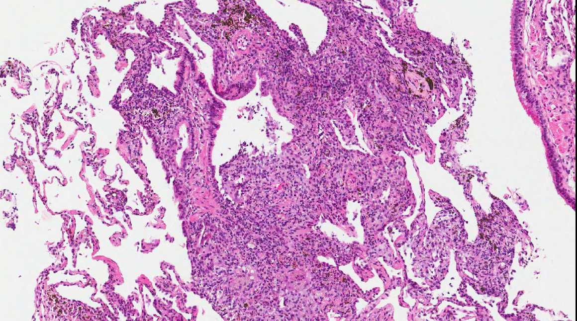 Pathology Outlines Lipoid pneumonia