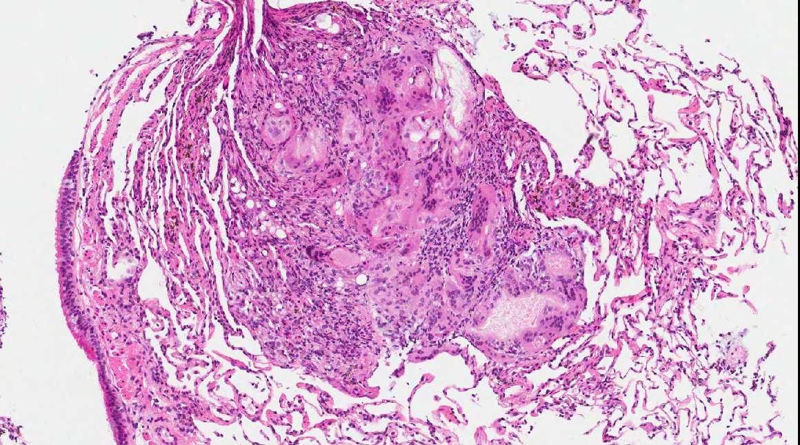 Pathology Outlines Lipoid pneumonia