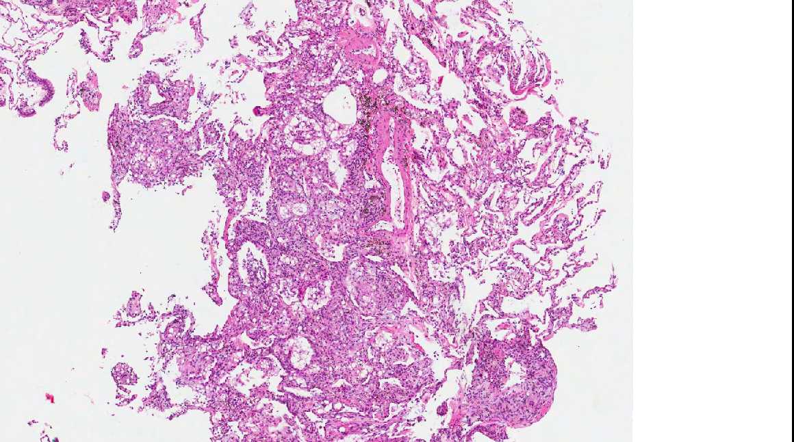 Pathology Outlines Lipoid pneumonia