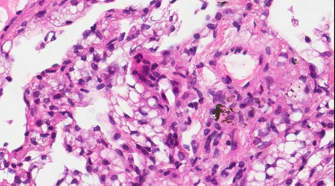 Pathology Outlines Lipoid pneumonia