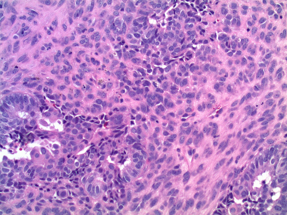 Pathology Outlines Endometrioid carcinoma
