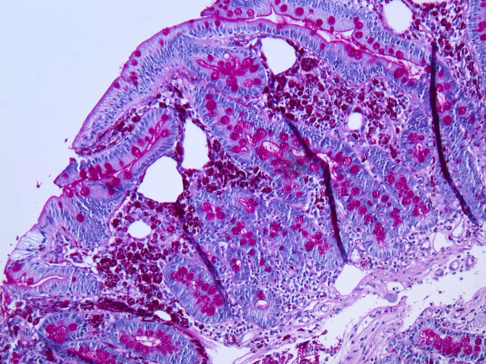 Pathology Outlines Whipple disease