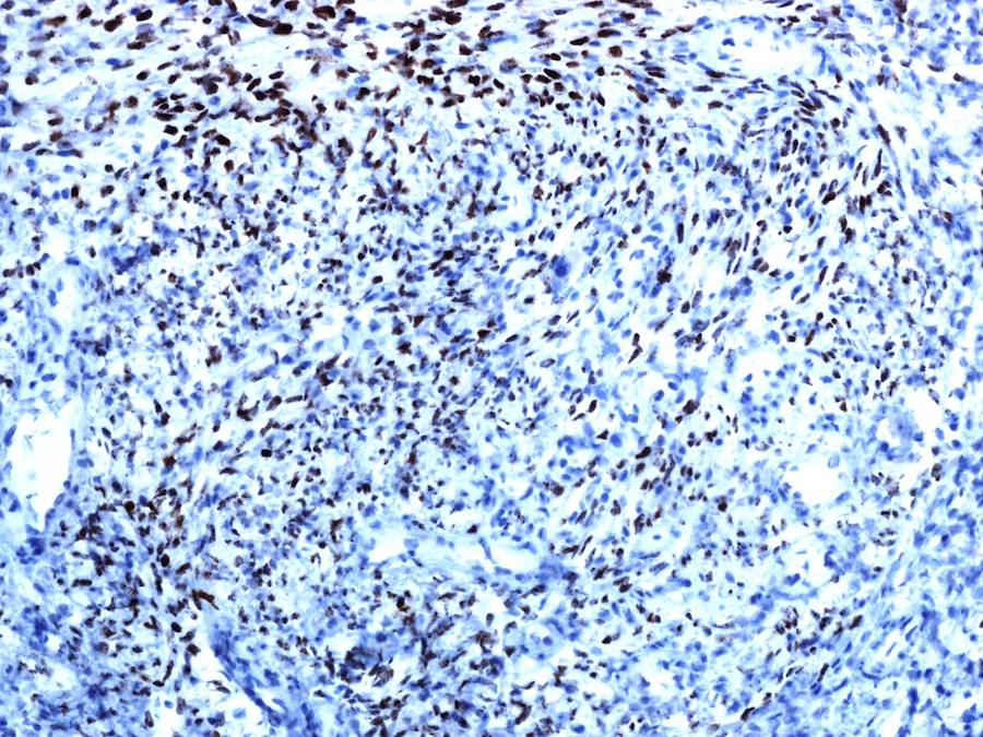 Pathology Outlines Kaposi