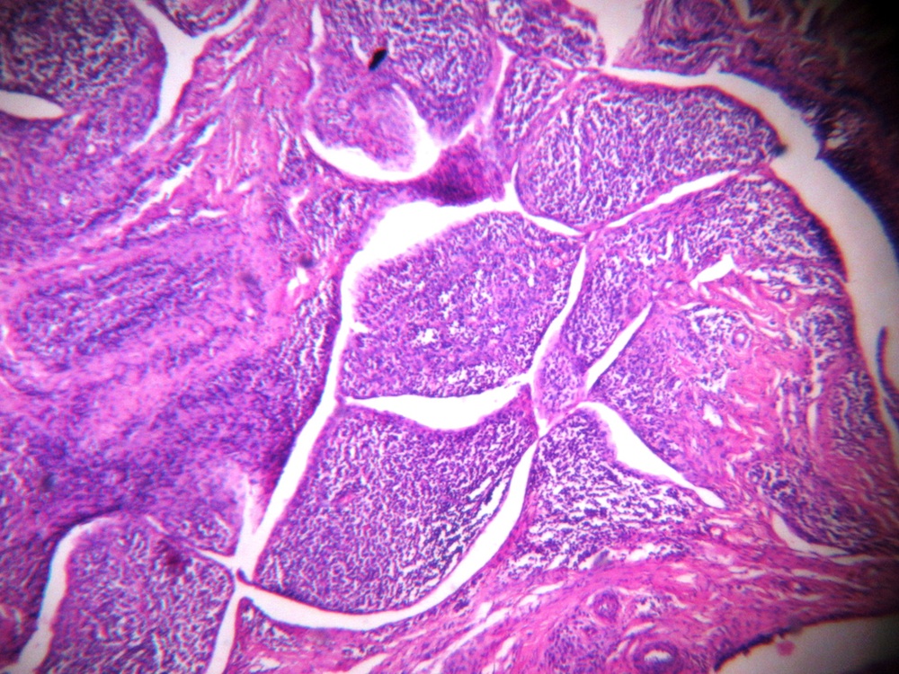 Pathology Outlines Rheumatoid arthritis