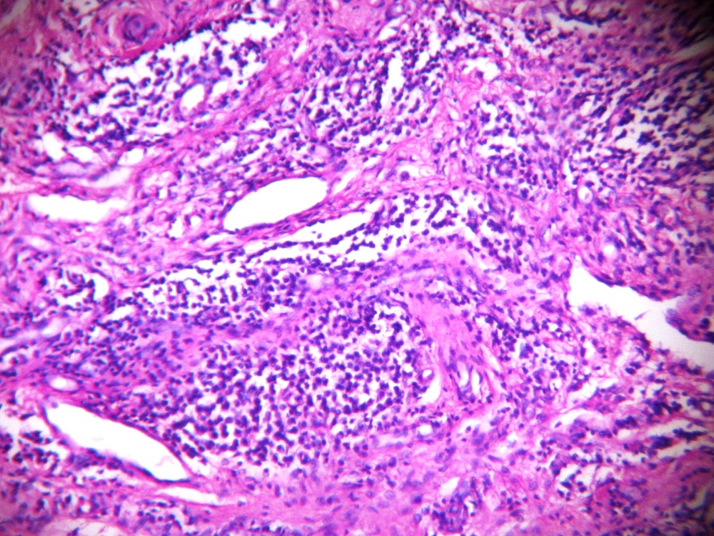 Pathology Outlines Rheumatoid arthritis