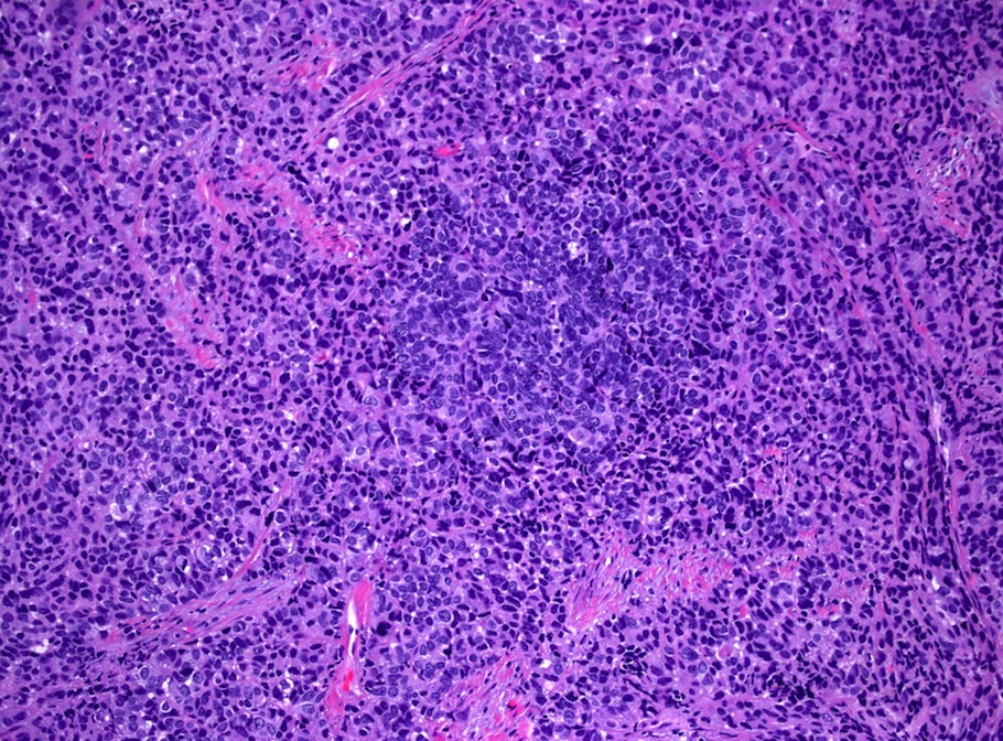 Pathology Outlines Large cell neuroendocrine carcinoma