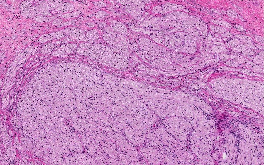 Pathology Outlines Traumatic neuroma