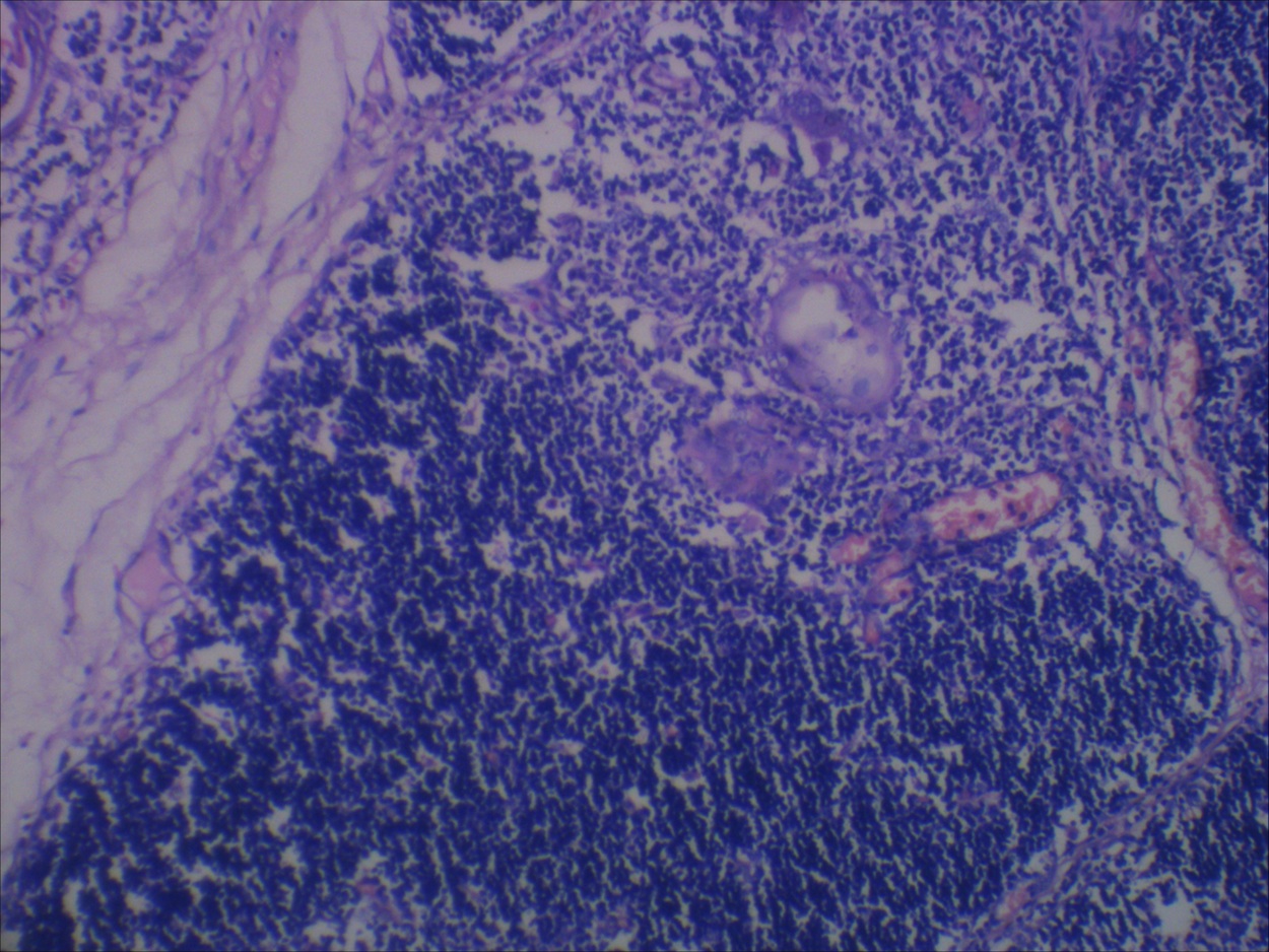Pathology Outlines Thymic cyst
