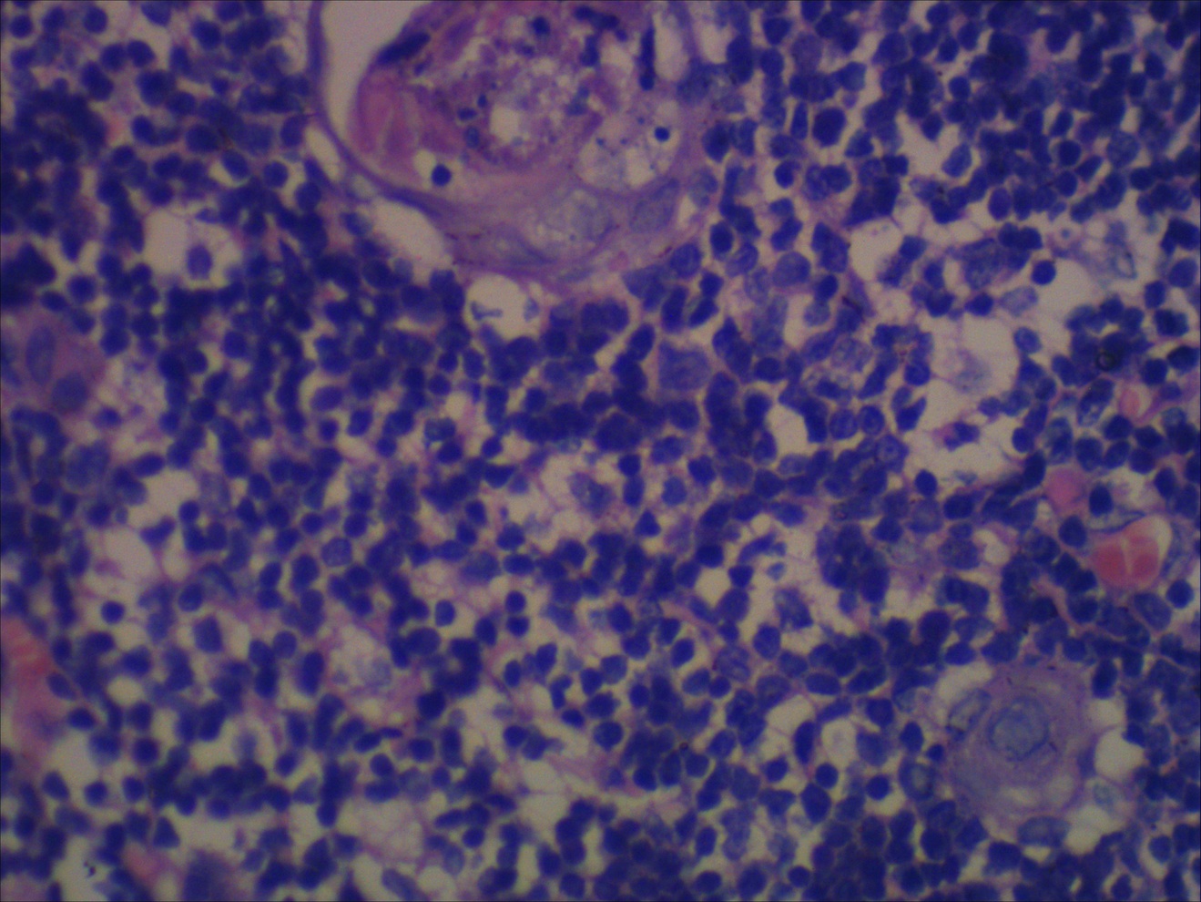 Pathology Outlines Thymic cyst