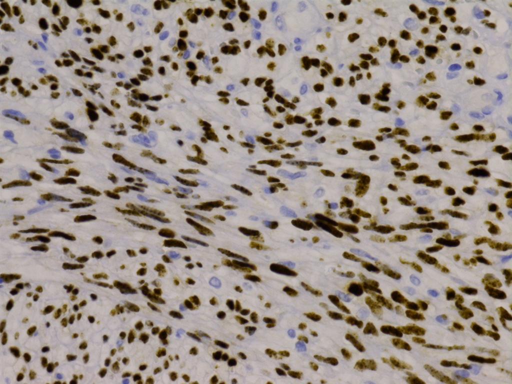 Pathology Outlines Kaposi