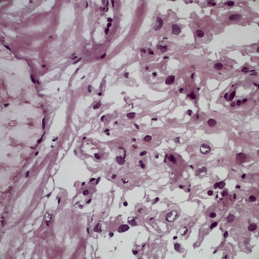 Pathology Outlines Meningioma
