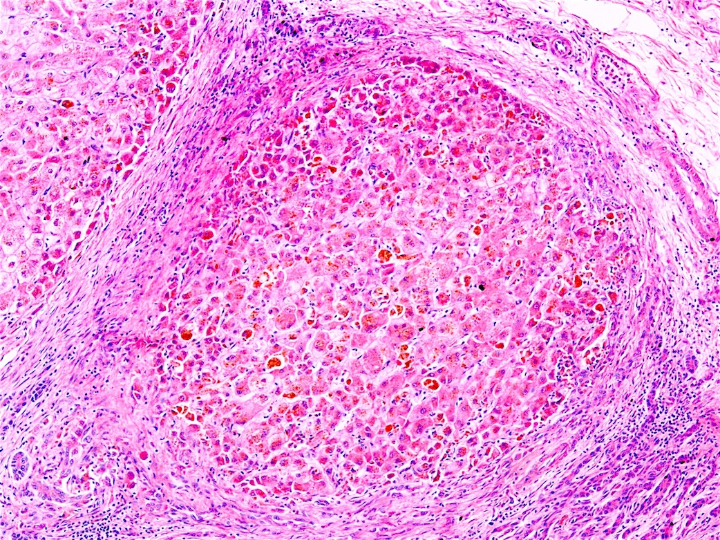 Pathology Outlines Wilson disease