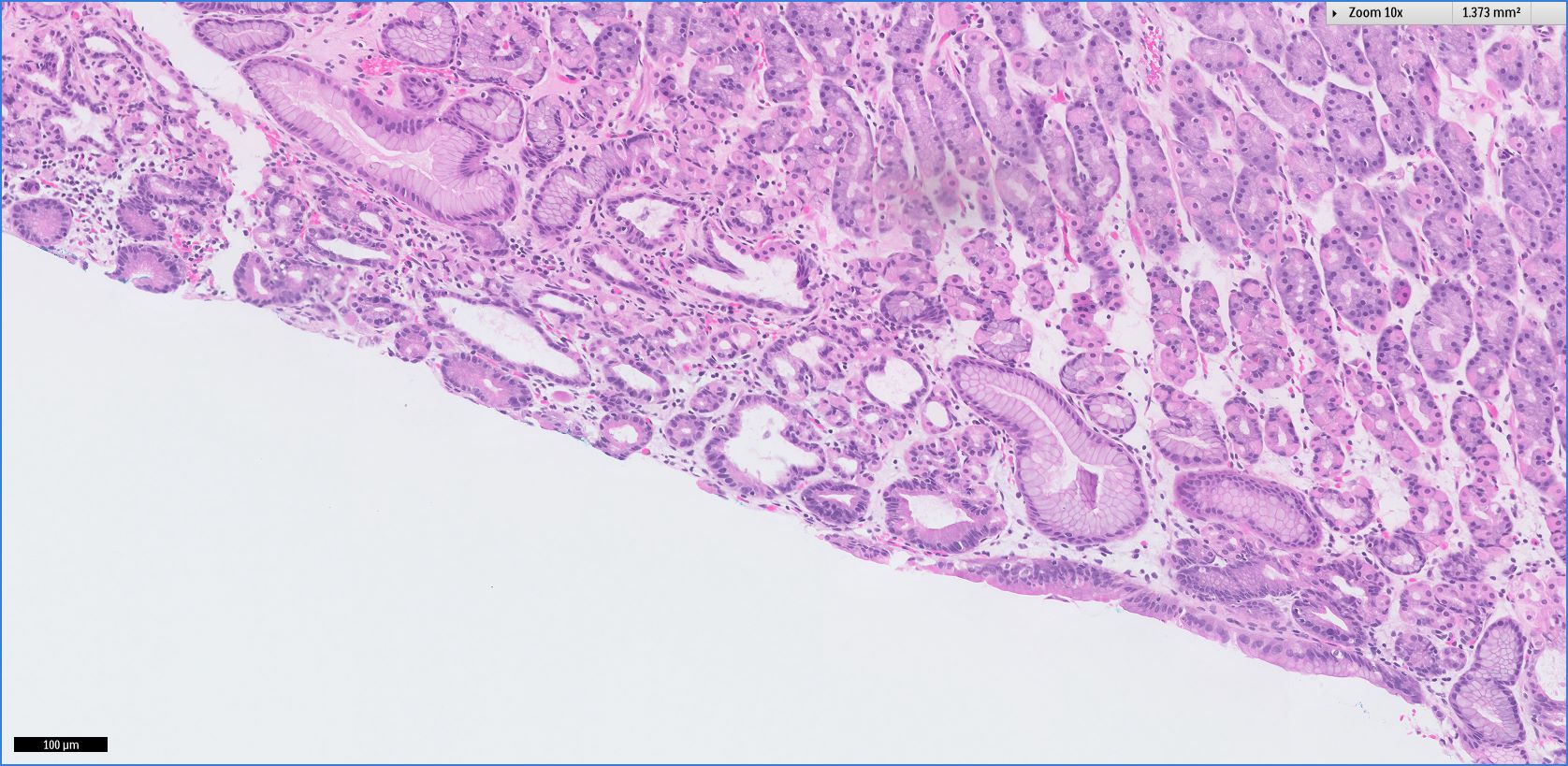 Pathology Outlines Fundic gland polyp