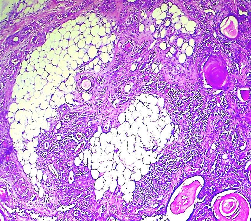 Pathology Outlines Pleomorphic adenoma