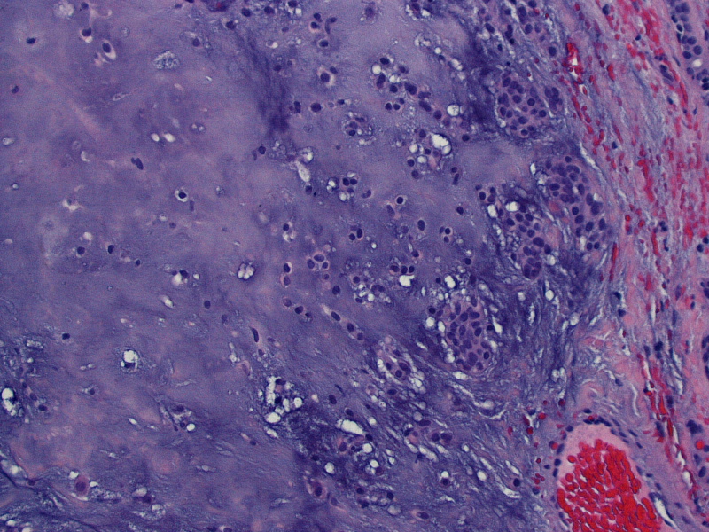 Pathology Outlines Pleomorphic adenoma