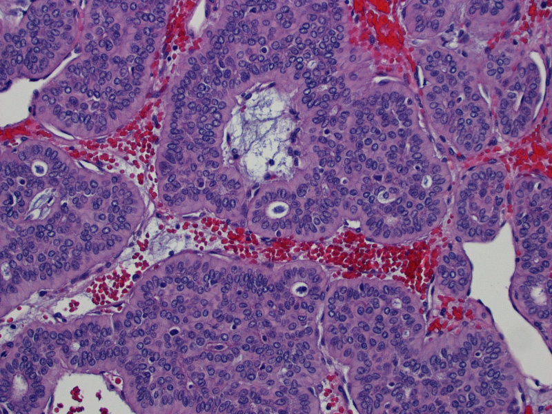Pathology Outlines Pleomorphic adenoma