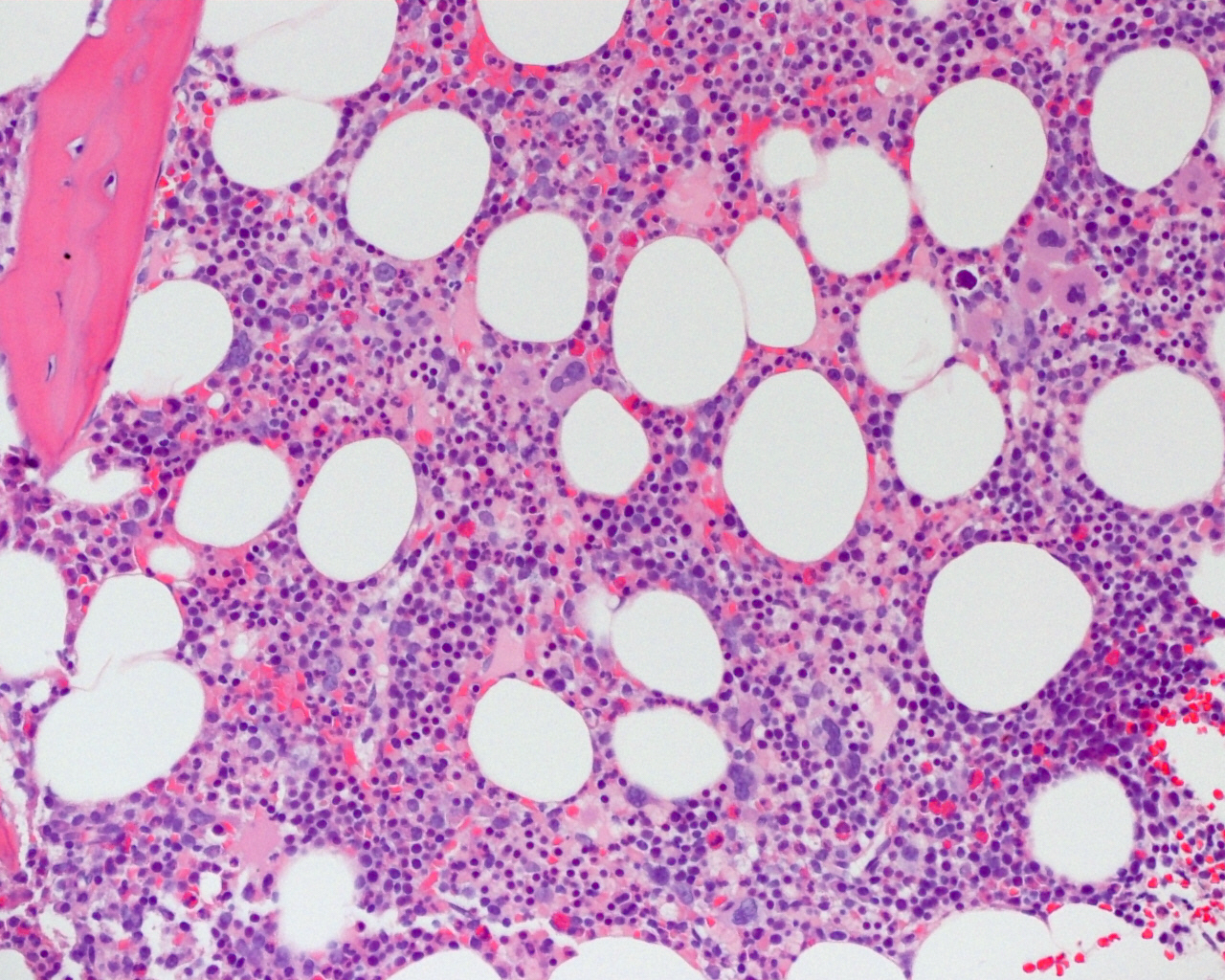 Pathology Outlines Hairy cell leukemia variant