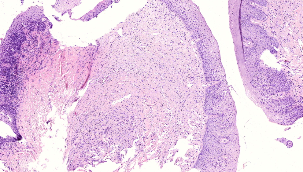 Pathology Outlines Subgemmal neurogenous plaque