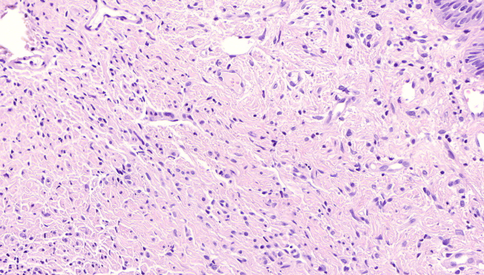 Pathology Outlines Subgemmal neurogenous plaque