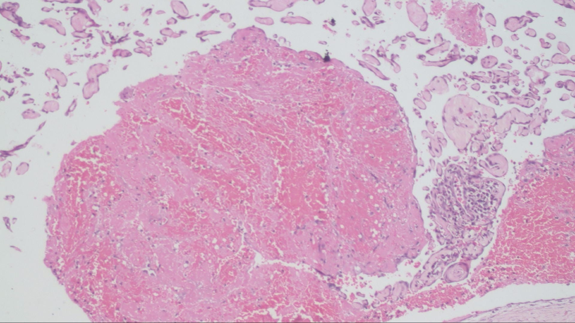 Thrombosed Hemorrhoid Histology