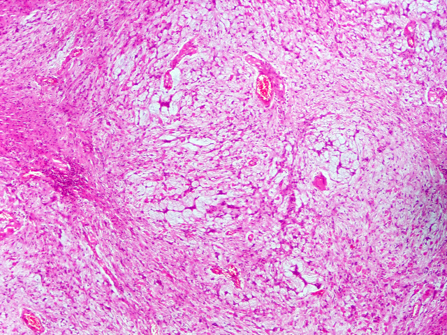 Pathology Outlines Schwannoma