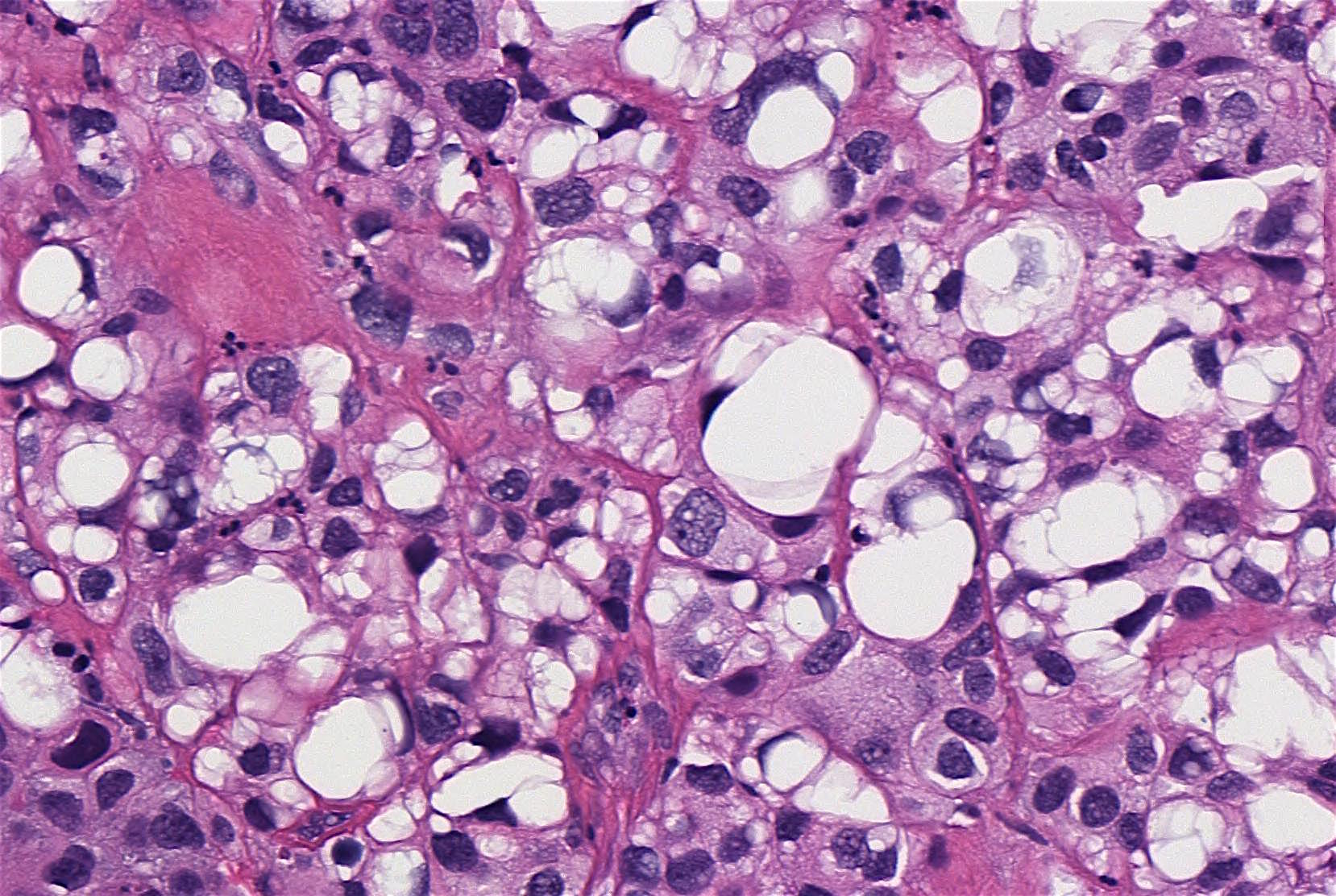Pathology Outlines Lipidrich