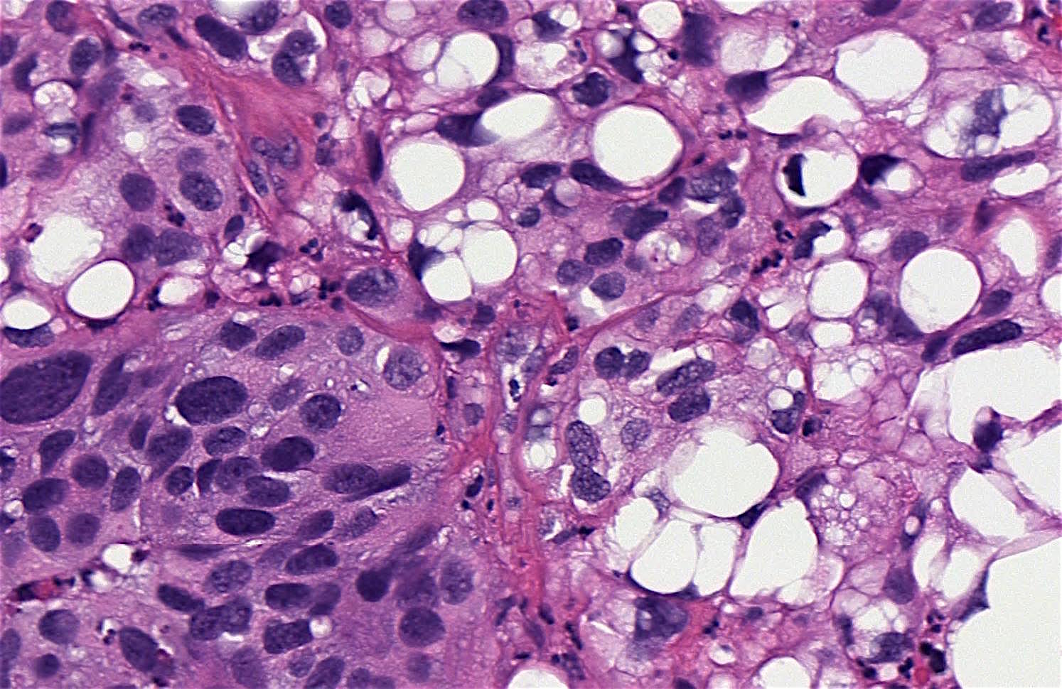 Pathology Outlines Urothelial carcinoma, lipid cell variant