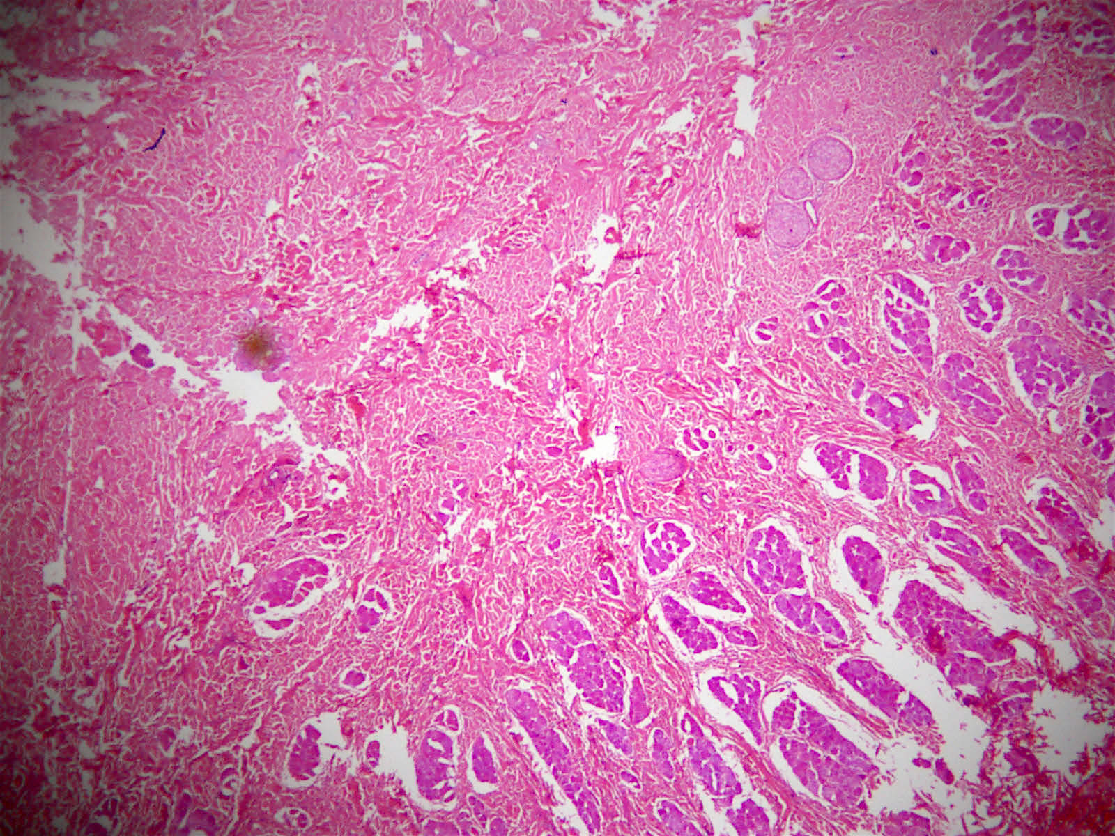Pathology Outlines Nuchaltype and Gardnerassociated fibroma