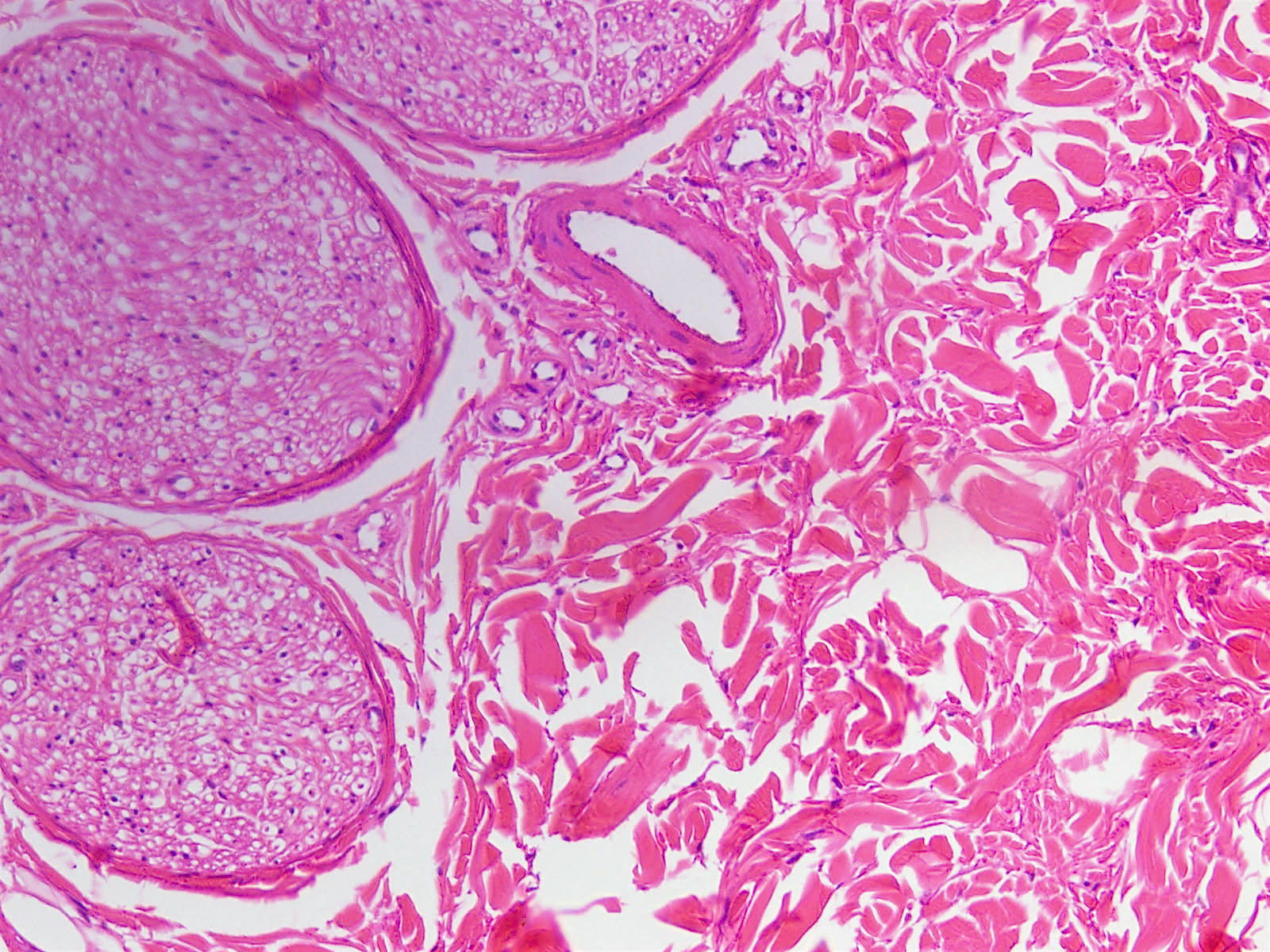 Pathology Outlines Nuchaltype fibroma