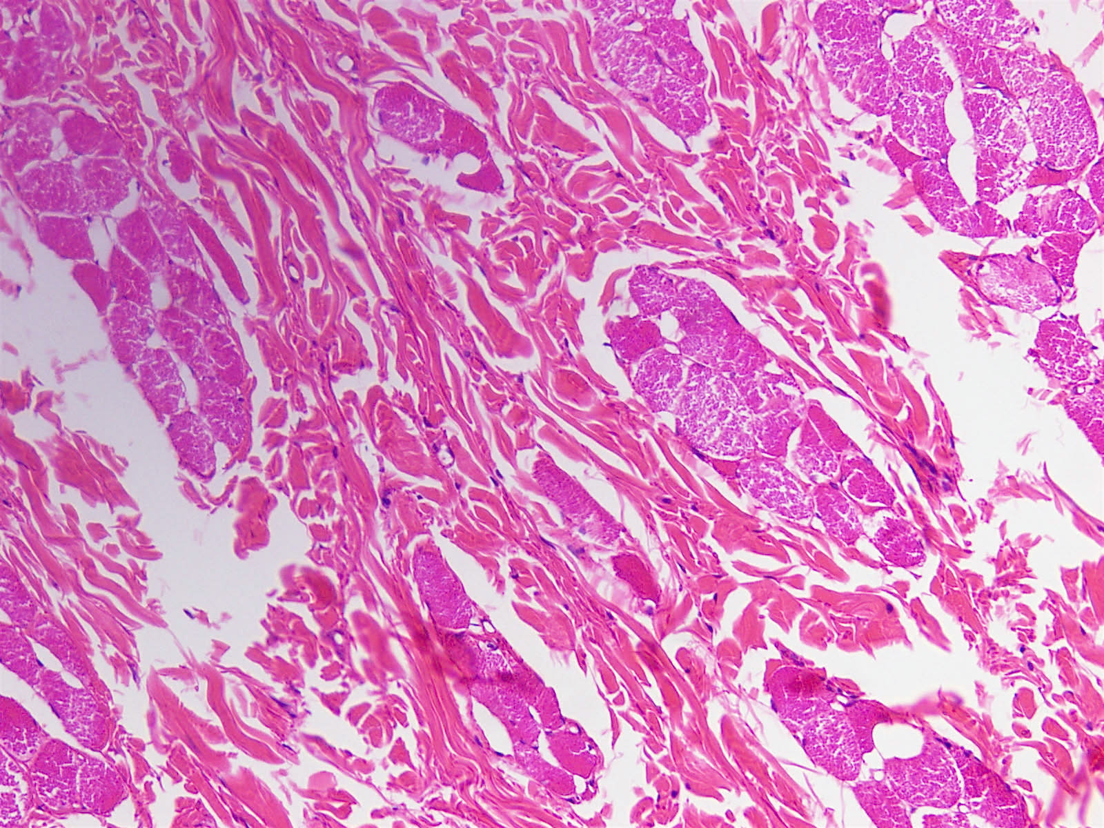 Pathology Outlines Nuchaltype and Gardnerassociated fibroma