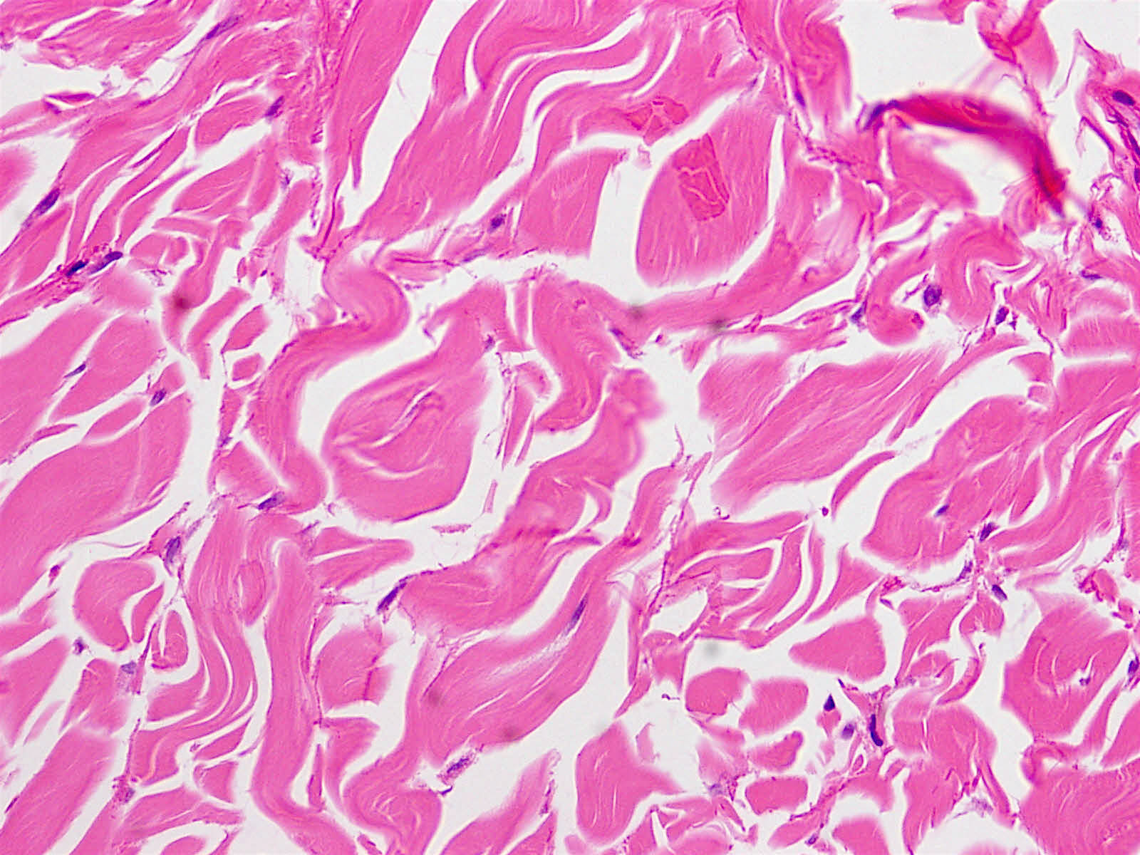 Pathology Outlines Nuchaltype fibroma
