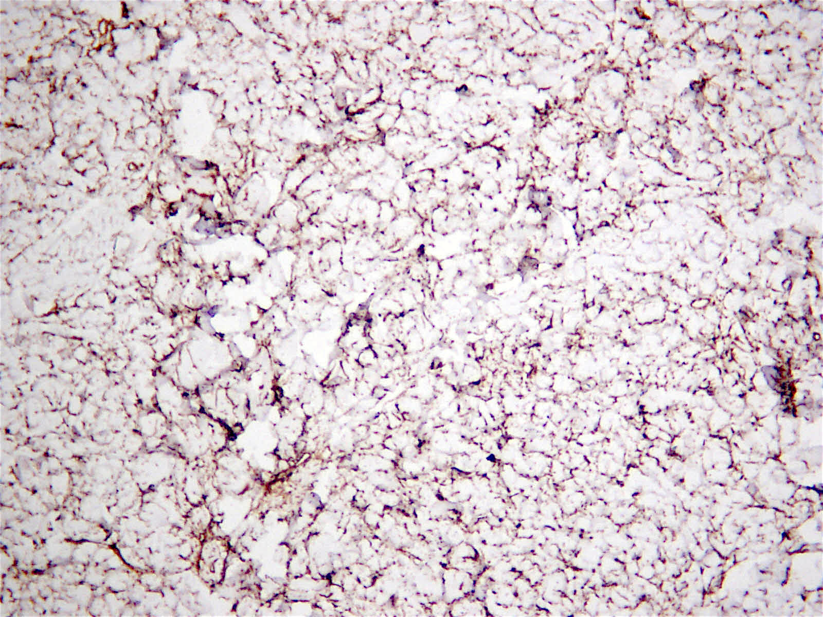 Pathology Outlines Nuchaltype fibroma
