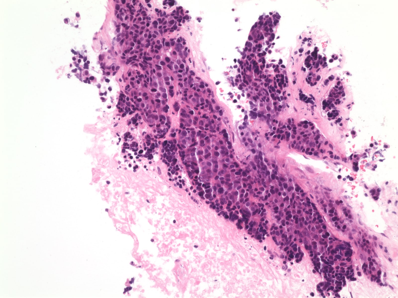 Pathology Outlines Thymic squamous cell carcinoma