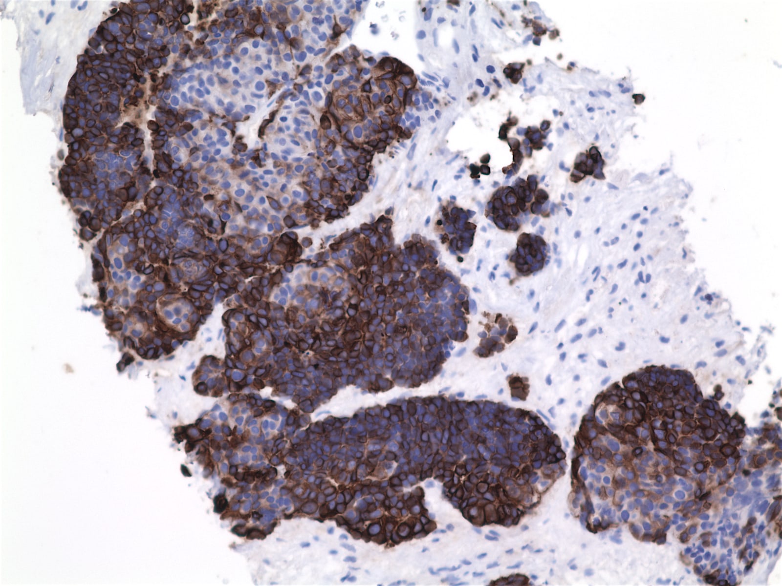 Pathology Outlines Thymic squamous cell carcinoma