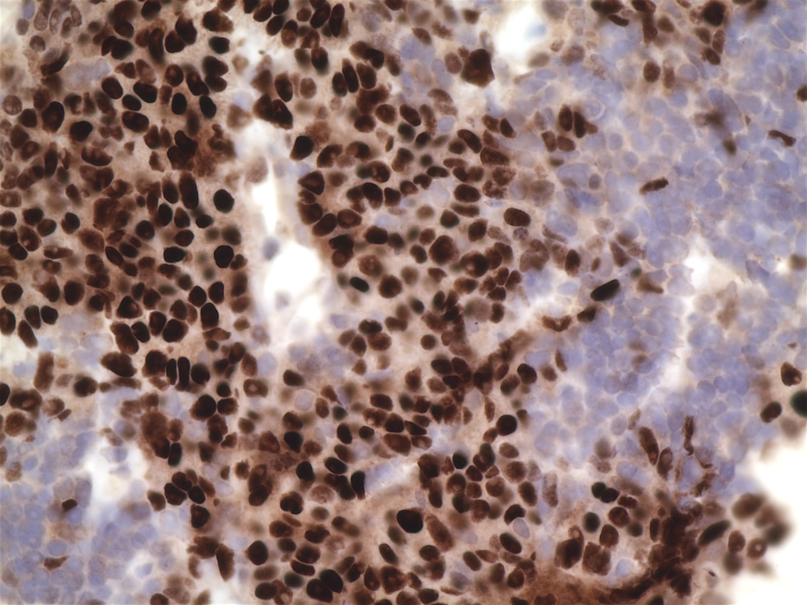 Pathology Outlines Thymic squamous cell carcinoma