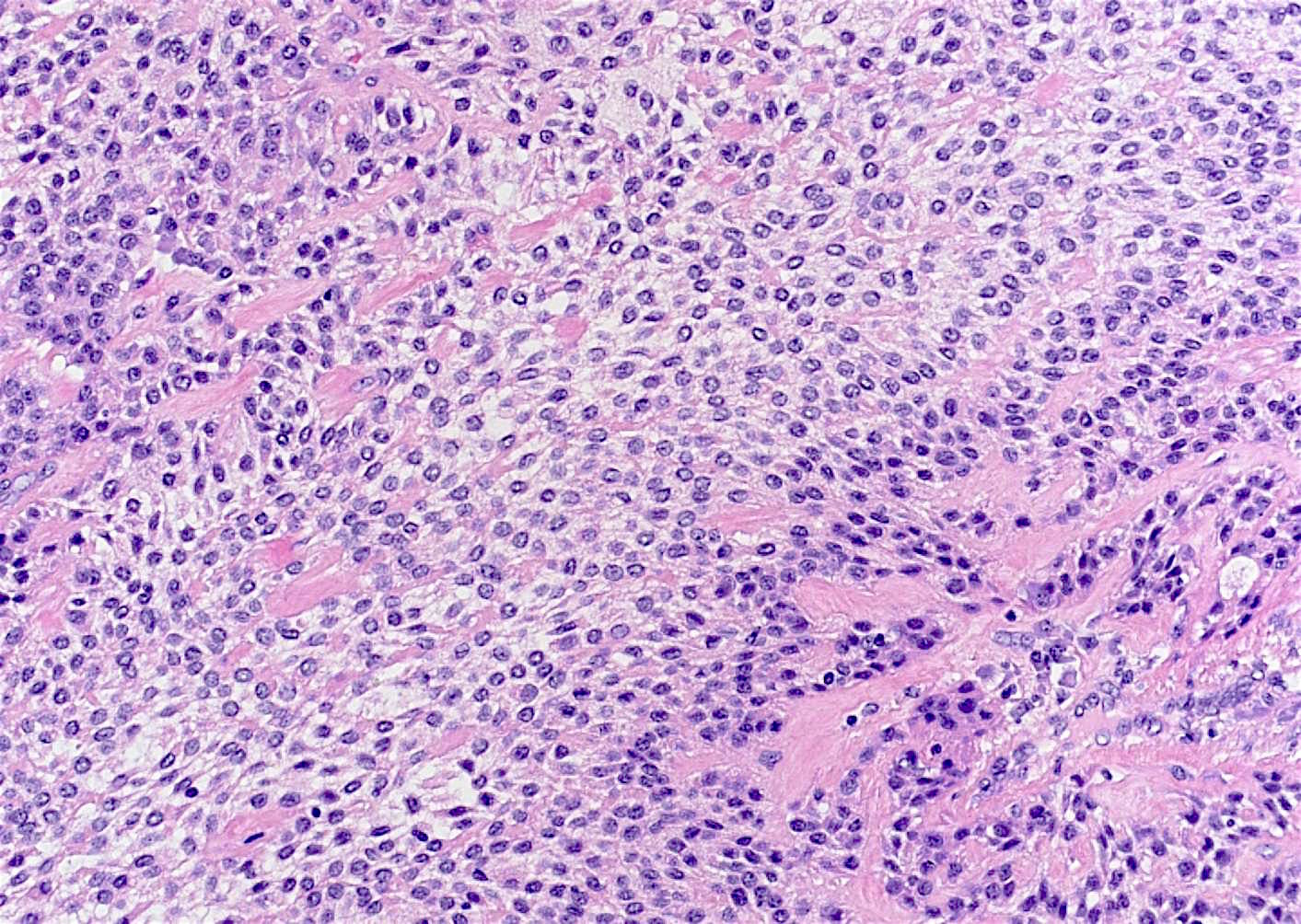 Pathology Outlines Clear cell carcinoma of salivary gland