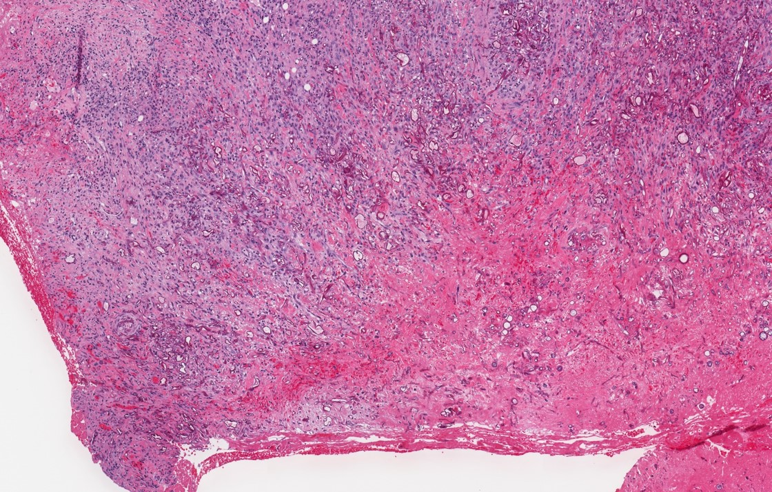 Pathology Outlines Invasive fungal sinusitis