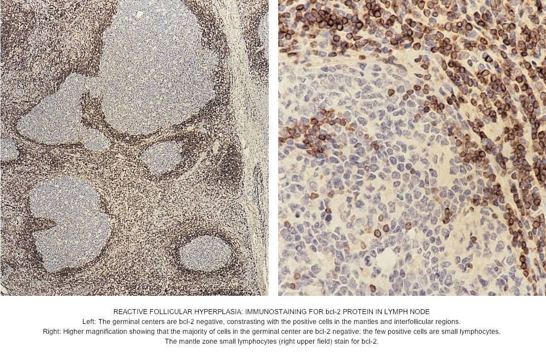 Pathology Outlines Follicular hyperplasia