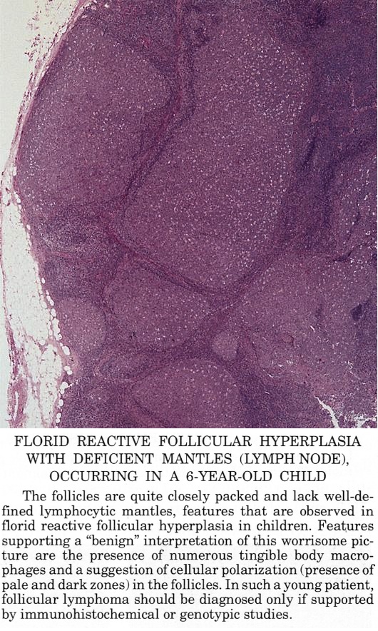 Pathology Outlines Follicular hyperplasia