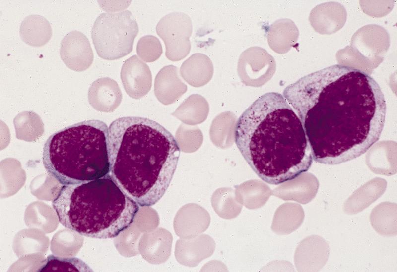 Pathology Outlines AML with maturation (FAB AML M2)